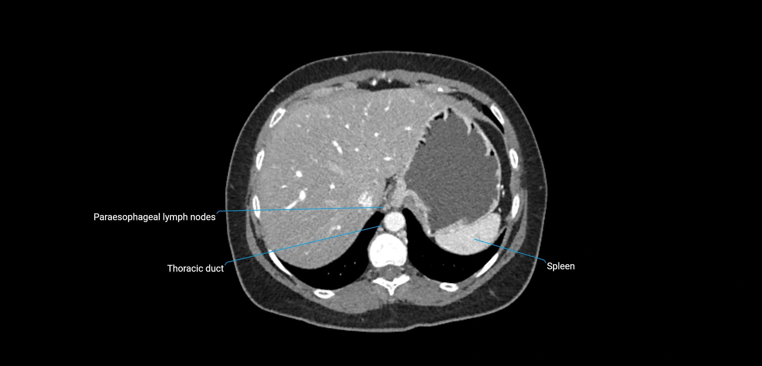 CT ct abdominal lymph nodes  axial cross sectional anatomy  enchanced radiology image -img-00002-00093.webp
